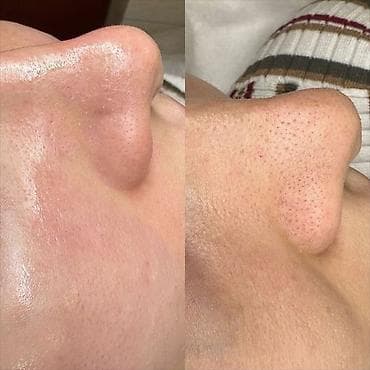 Косметология, Чистка кожи, Консультация, Гипоаллергенные материалы, Сертифицированный косметолог