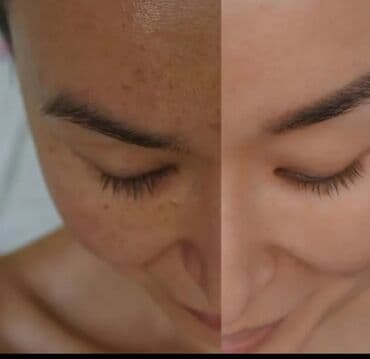 накладные брекеты для красоты купить: Косметология, Пилинг, Чистка кожи, Консультация, Гипоаллергенные материалы, Сертифицированный косметолог — 7