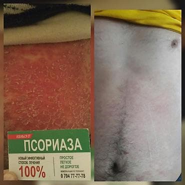 мазь: Здравствуйте! Найден эффективный способ от Псориаза. Я сам болею этой — 9