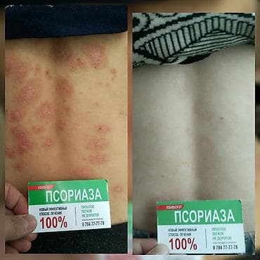 мазь: Здравствуйте! Найден эффективный способ от Псориаза. Я сам болею этой — 5