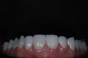 Медицина, фармацевтика: Эстетическая реставрация передних зубов: керамические виниры/коронки — 2