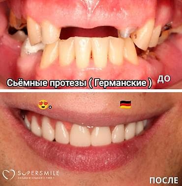 протезы для ног: Съёмные зубные протезы под ваши задачи - Вакуумные протезы: плотная — 4