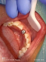 хиджама кровопускание: Клиника | Стоматолог | Протезирование — 11