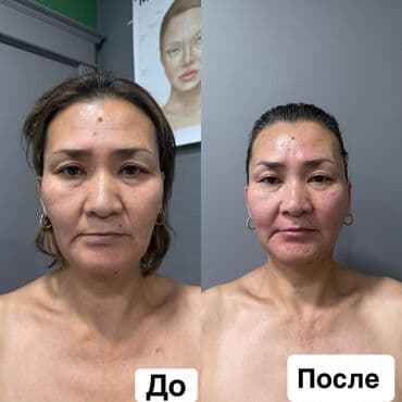 нейлоновые зубные протезы в бишкеке цены: Косметология увлажнение кожи лица ботекс и многое другое Для мужчин — 5