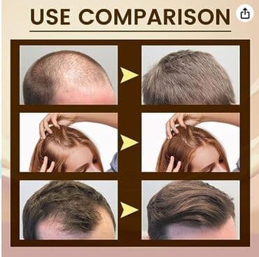 шампунь дисаар: ❄️ сша с аmazon сыворотка для лечения волос от выпадения волос от — 8