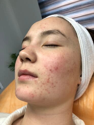 сколько стоит операция варикоцеле в бишкеке: Косметология, Лечение угревой болезни, Биоревитализация, Маски, Консультация, Сертифицированный косметолог — 3