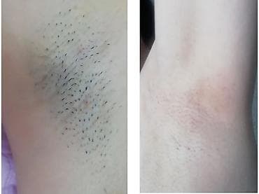 лечебные массаж ош: Лазерная эпиляция. Чистка лица. Лечение акне. Гименопластика — 2