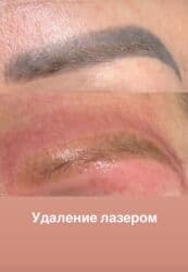 визажное кресло: Продаю лазерный аппарат для удаления татуажа, перманента, татуировок — 4