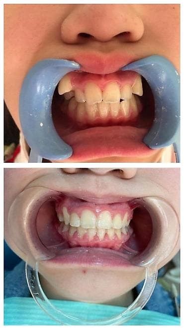 брекеты цена бишкек 2020: К вашему вниманию предоставляется услуга по установке брекет-системы — 2