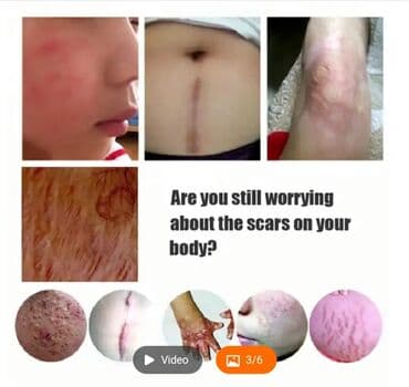 растяжки: Восстанавливающая эссенция LAVENDER . Масло для удаления растяжек и — 6