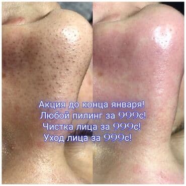 чистка лица: Косметология, Маски, Массаж лица, Отбеливание пигментных пятен, Консультация, Гипоаллергенные материалы, Сертифицированный косметолог — 1