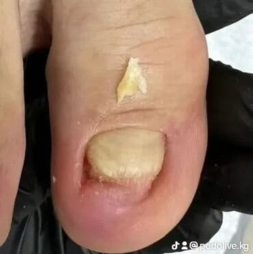 маникюр педикюр с выездом на дом: Коррекция вросших ногтей, Выравнивание, Услуги подолога, Маникюр, Педикюр, С выездом на дом, Консультация, Одноразовые расходные материалы — 4