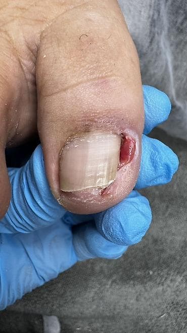 педикюр для мужчин: Коррекция вросших ногтей, Педикюр, Услуги подолога, Консультация — 2