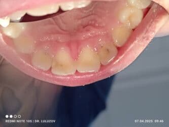 хиджама кровопускание: Клиника | Стоматолог | Протезирование — 21