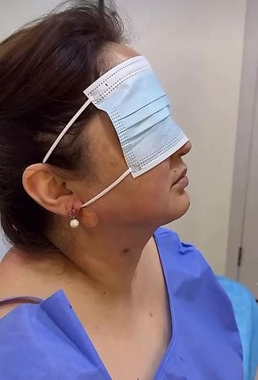 лицо: Липосакция второго подбородка и брыли по Акции вместо 35000с со — 7