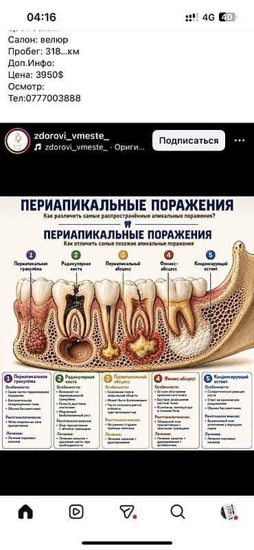 зуб мудрости: Клиника | Стоматолог | Протезирование — 4