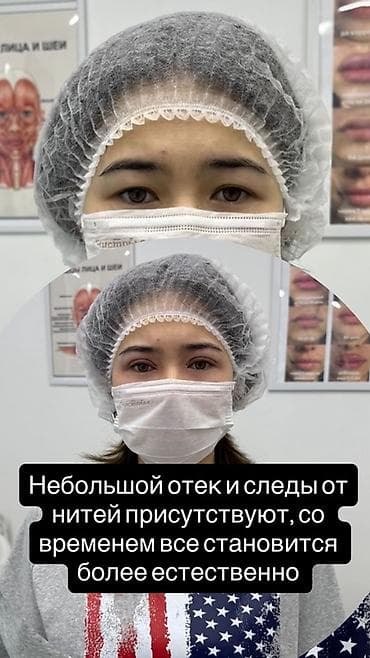 ihone x: Нитевая блефаропластика «Сингапури» без операции ✨ Процедура — 4