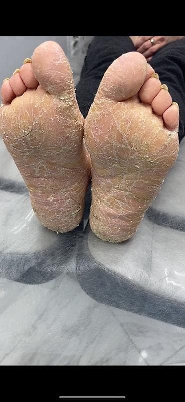 кремы: Коррекция вросших ногтей, Педикюр, Одноразовые расходные материалы — 1