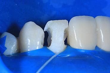 Реставрация передних зубов композитом (эстетическая пломба) - — 3