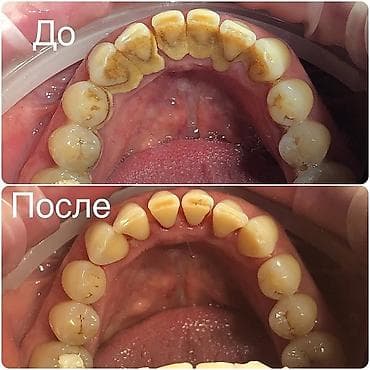 1)Профессиональная 3-х этапная гигиена полости рта (ультразвук