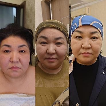 подтяжка лица: Косметология, Контурное моделирование, Массаж лица, Лифтинг, Консультация, Гипоаллергенные материалы — 4