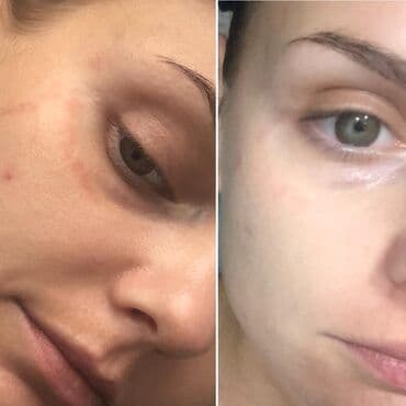 эффективный отбеливающий крем для зоны бикини в аптеке: Expigment Экспигмент Сроки до 2027 Свежая поставка с Турции 🇹🇷 💯% — 17