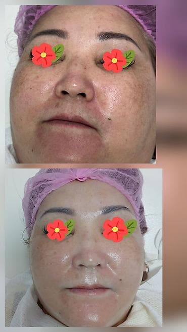 Косметология, Биоревитализация, Лечение угревой болезни, Маски, Консультация, Гипоаллергенные материалы, Сертифицированный косметолог