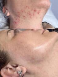 гель для узи: Комбинированная чистка лица: механическая + ультразвуковая — 8