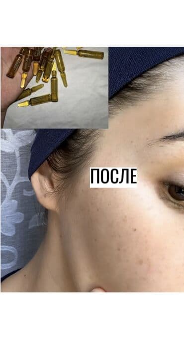 крем для отбеливания кожи и устранения пигментных пятен: JUWAY 377 — отбеливающая эссенция против пигментации и акне в ампулах — 3