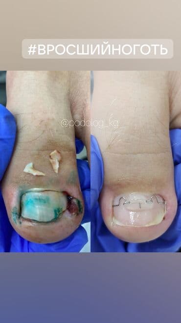 самый лучший эндокринолог рядом просп жибек жолу бишкек: Коррекция вросших ногтей, Услуги подолога, Маникюр, Педикюр, Одноразовые расходные материалы, Консультация — 2