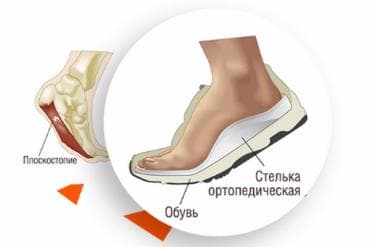 белорусская обувь для проблемных ног: Стельки ортопедические(специализированные) от плоскостопия Для — 1