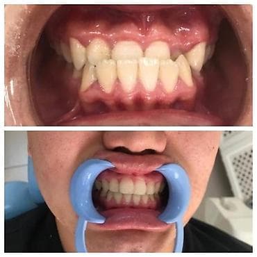 брекеты цена бишкек 2020: К вашему вниманию предоставляется услуга по установке брекет-системы — 3