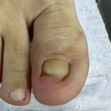 маникюр педикюр с выездом на дом: Коррекция вросших ногтей, Выравнивание, Услуги подолога, Маникюр, Педикюр, С выездом на дом, Консультация, Одноразовые расходные материалы — 3