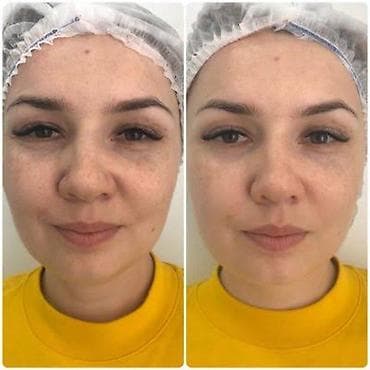 процедура: ✨ Нужны модели на увлажняющую мезотерапию! ✨ Хотите свежую — 2