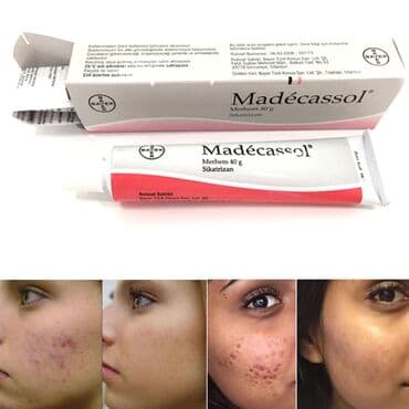 кардиомарин для варикоза: Мадекассол Madecassol Показания к применению рубцовые изменения кожи — 2