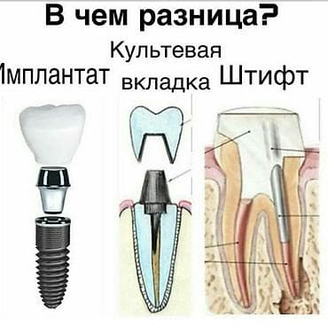 Имплантация зубов Одна этапные и двух этапные системы