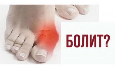 эспандер бабочка: Корректоры для большого пальца ноги от вальгусной деформации(косточки — 2