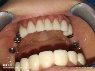 хиджама кровопускание: Клиника | Стоматолог | Протезирование — 20