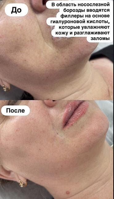 из пластика: Косметология, Увеличение губ, Консультация — 5