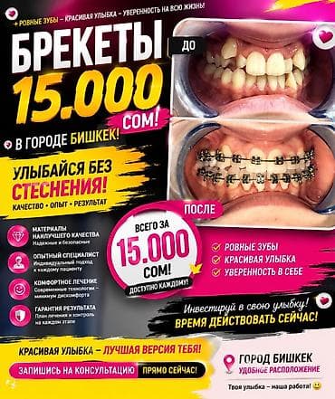 Брекеты в г. Бишкек — установка за 15 000 сом на обе челюсти Что