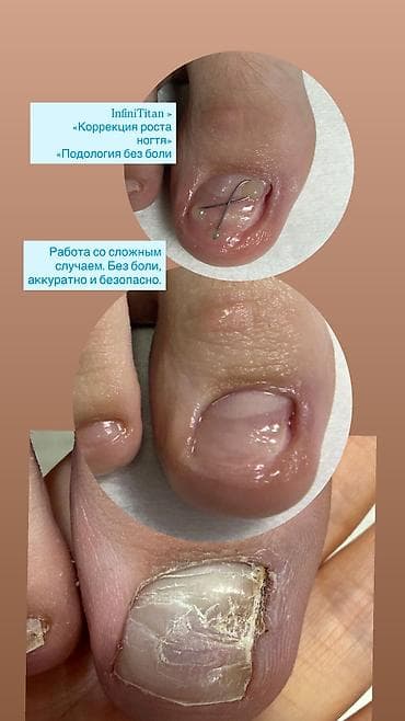 услуга маникюра и педикюра: Коррекция вросших ногтей, Услуги подолога, Консультация — 3