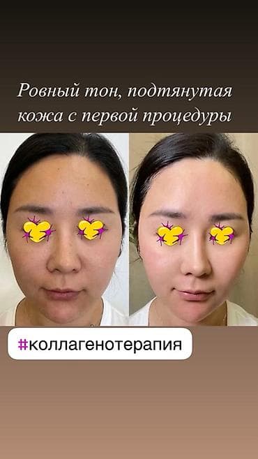 ава терапия: Коллагенотерапия и уход с экзосомами, пептидами и 8 видами коллагена — 10