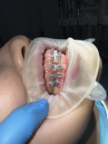 реставрация 4 зуба: Врачи | Стоматолог | Диагностика — 7