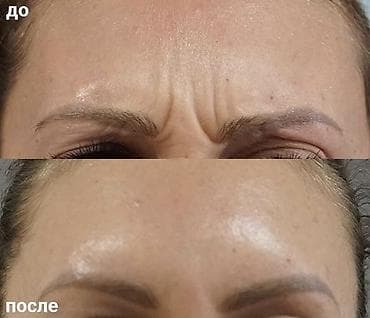 face: Косметологические услуги для лица и тела: 💎Ботокс -разглаживание — 3