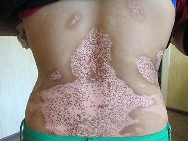 Нитриловые перчатки: Витилиго средство — 3