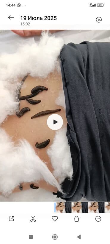 хиджама кровопускание: Врачи | Гирудотерапевт | Лечение пиявками — 8