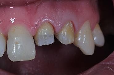 видео свадьба: Стоматологическая услуга: реставрация передних зубов с применением — 2