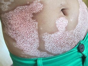 Нитриловые перчатки: Витилиго средство — 4