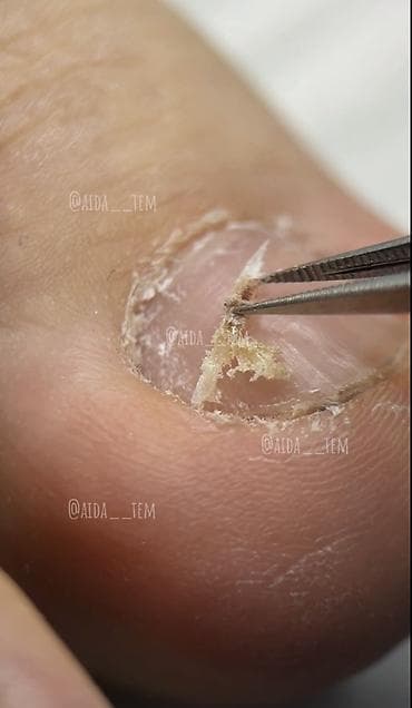 гвозди для ног: Коррекция вросших ногтей, Педикюр, Услуги подолога, Одноразовые расходные материалы — 1