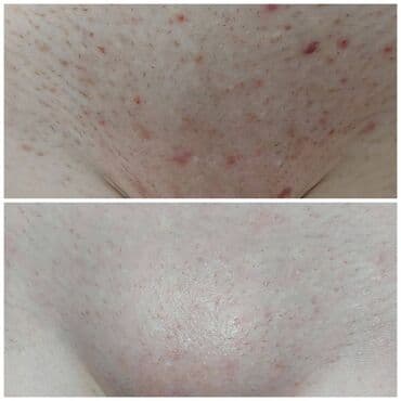 самый лучший эндокринолог рядом просп жибек жолу бишкек: Косметология, Контурное моделирование, Лечение угревой болезни, Маски, Консультация, Гипоаллергенные материалы, Сертифицированный косметолог — 8